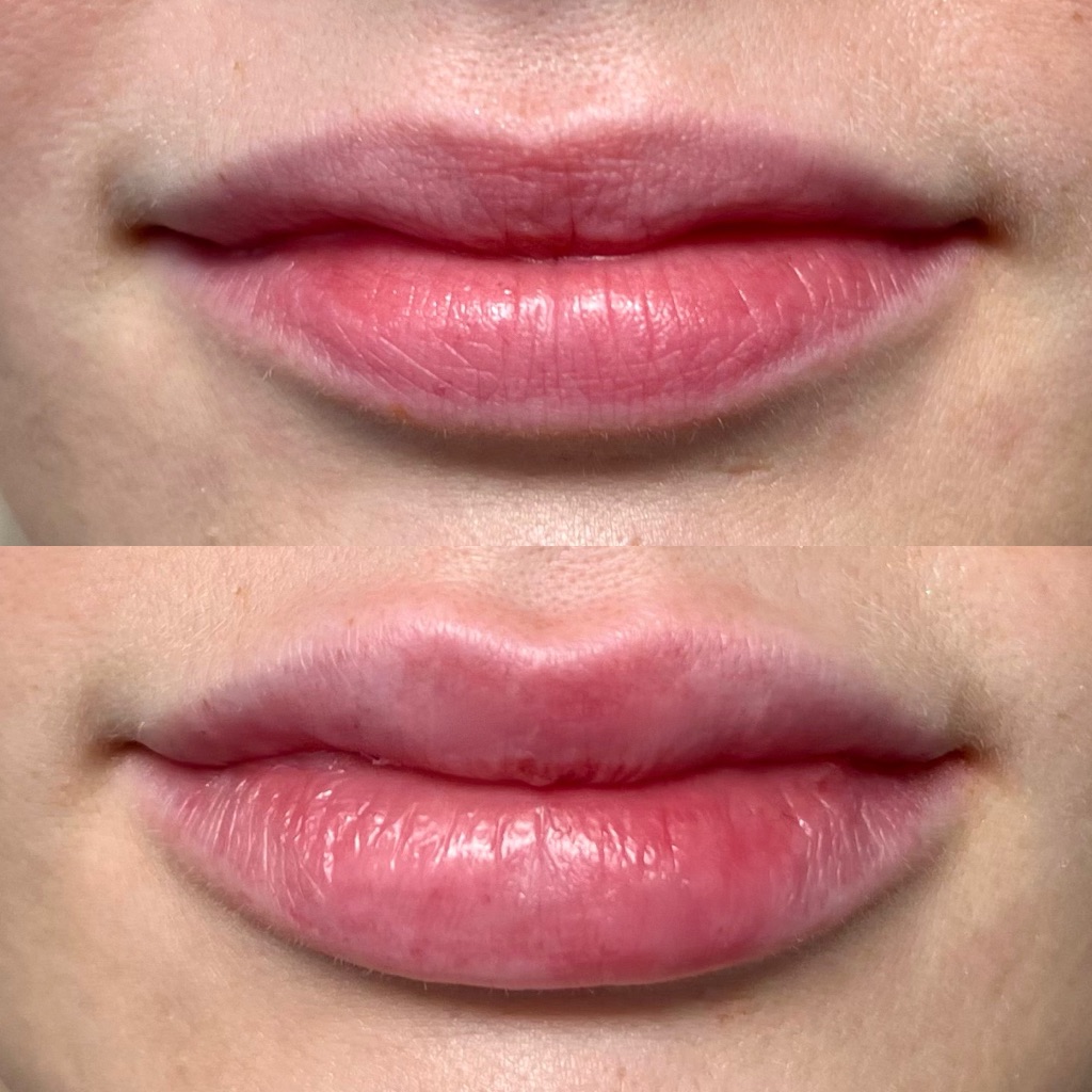 Lips 2
