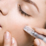 Microneedling mit PRP: Natürliche Hautregeneration für mehr Ausstrahlung
