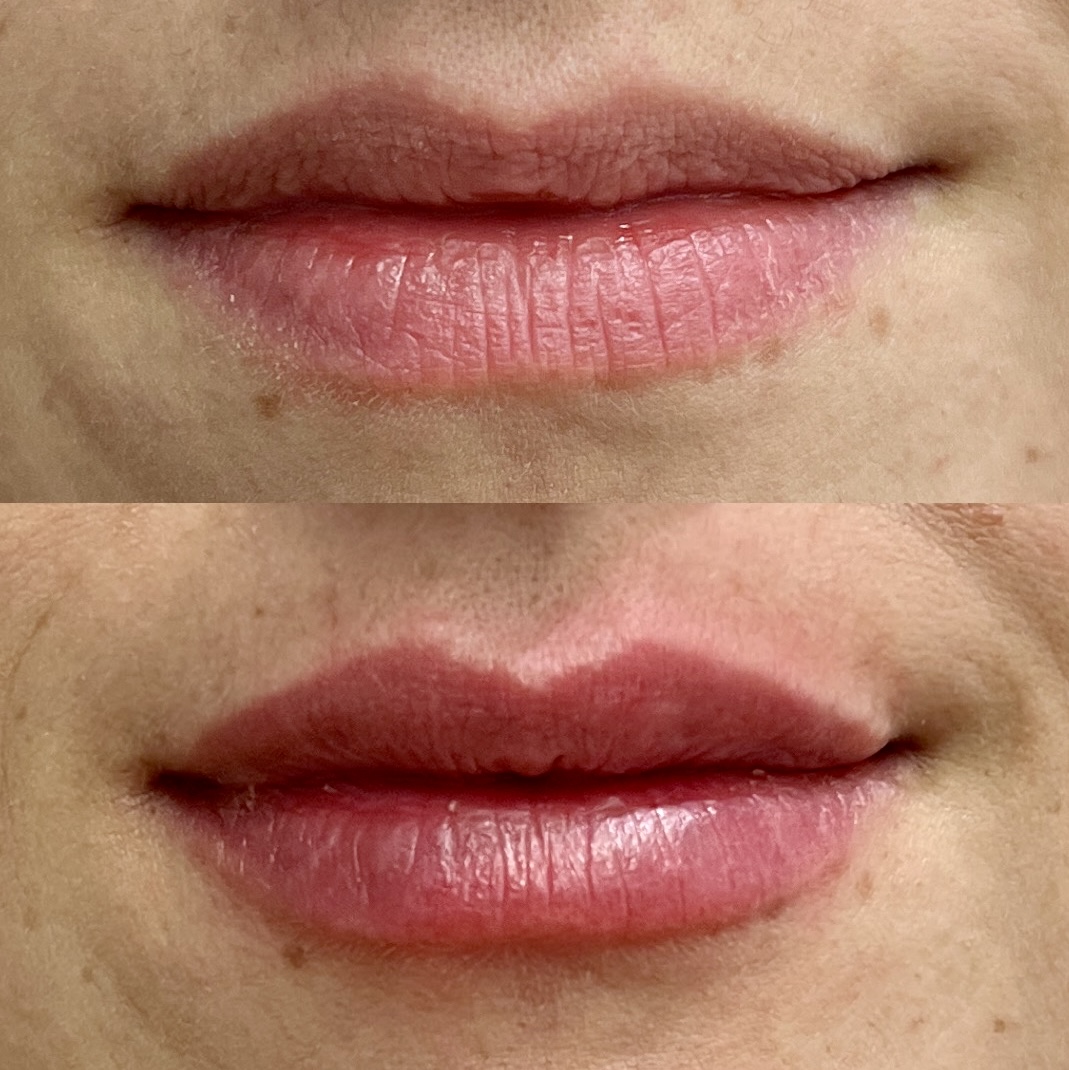 Lippen B&A 1
