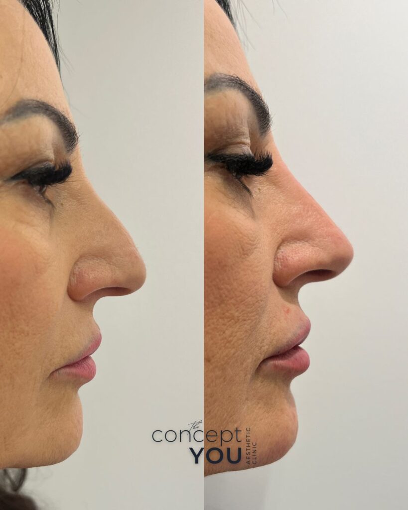 Vorher-Nachher-Ergebnis zur sanften Korrektur des Nasenrückens Hyaluron, ConceptYOU Clinic