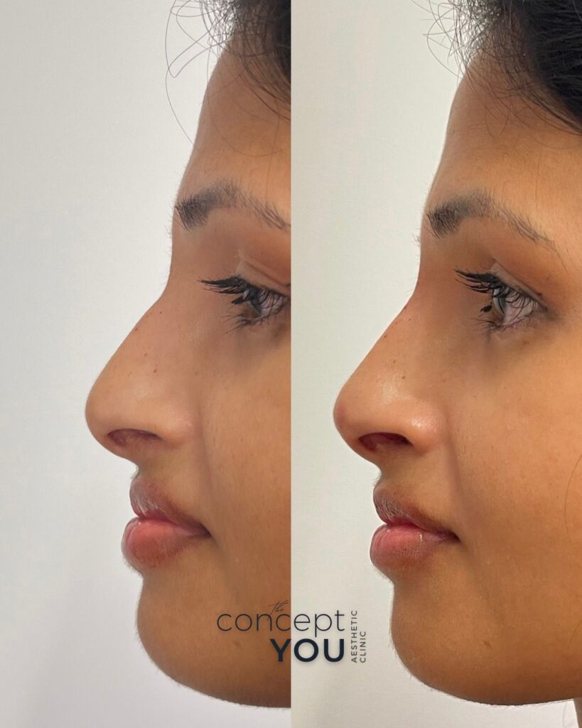 Vorher-nachher Vergleich einer Nasenkorrektur ohne OP mit Hyaluron zur Korrektur eines Nasenhöckers