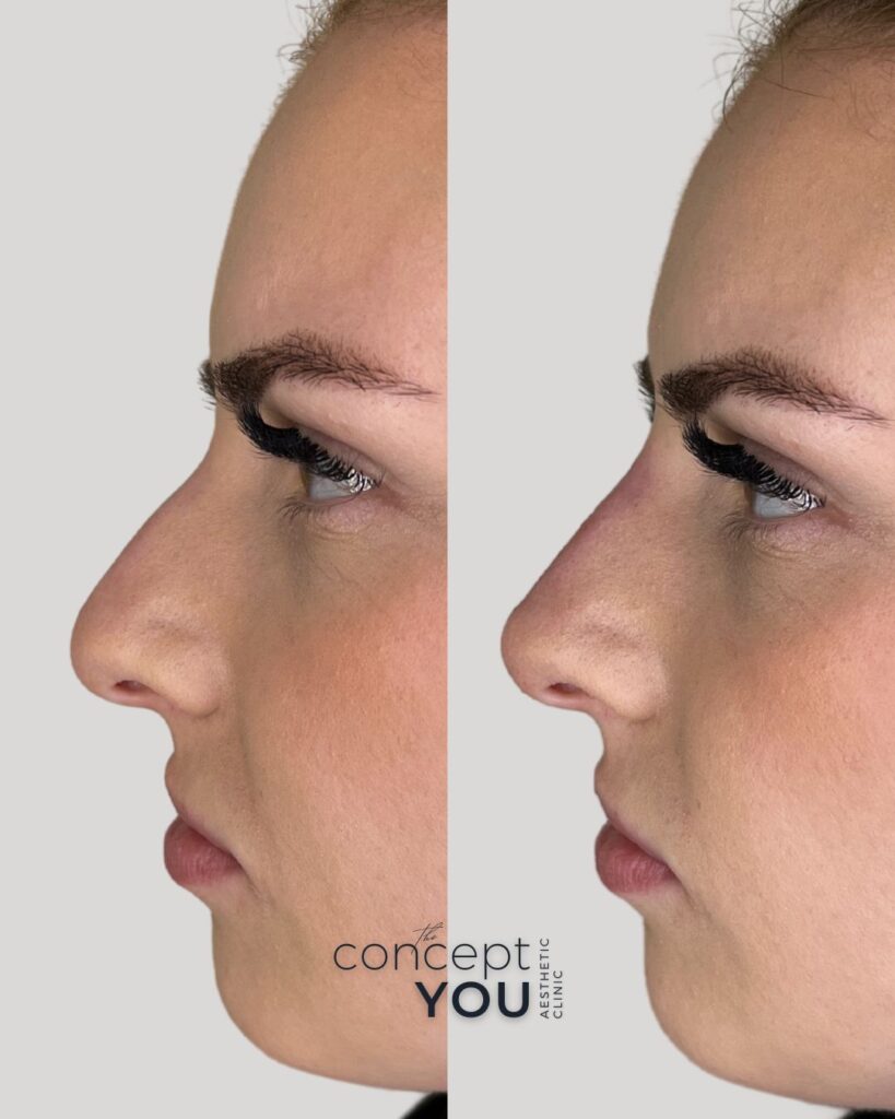 Vorher-Nachher-Bilder einer nicht operativen Nasenkorrektur zur Verbesserung des Nasenprofils