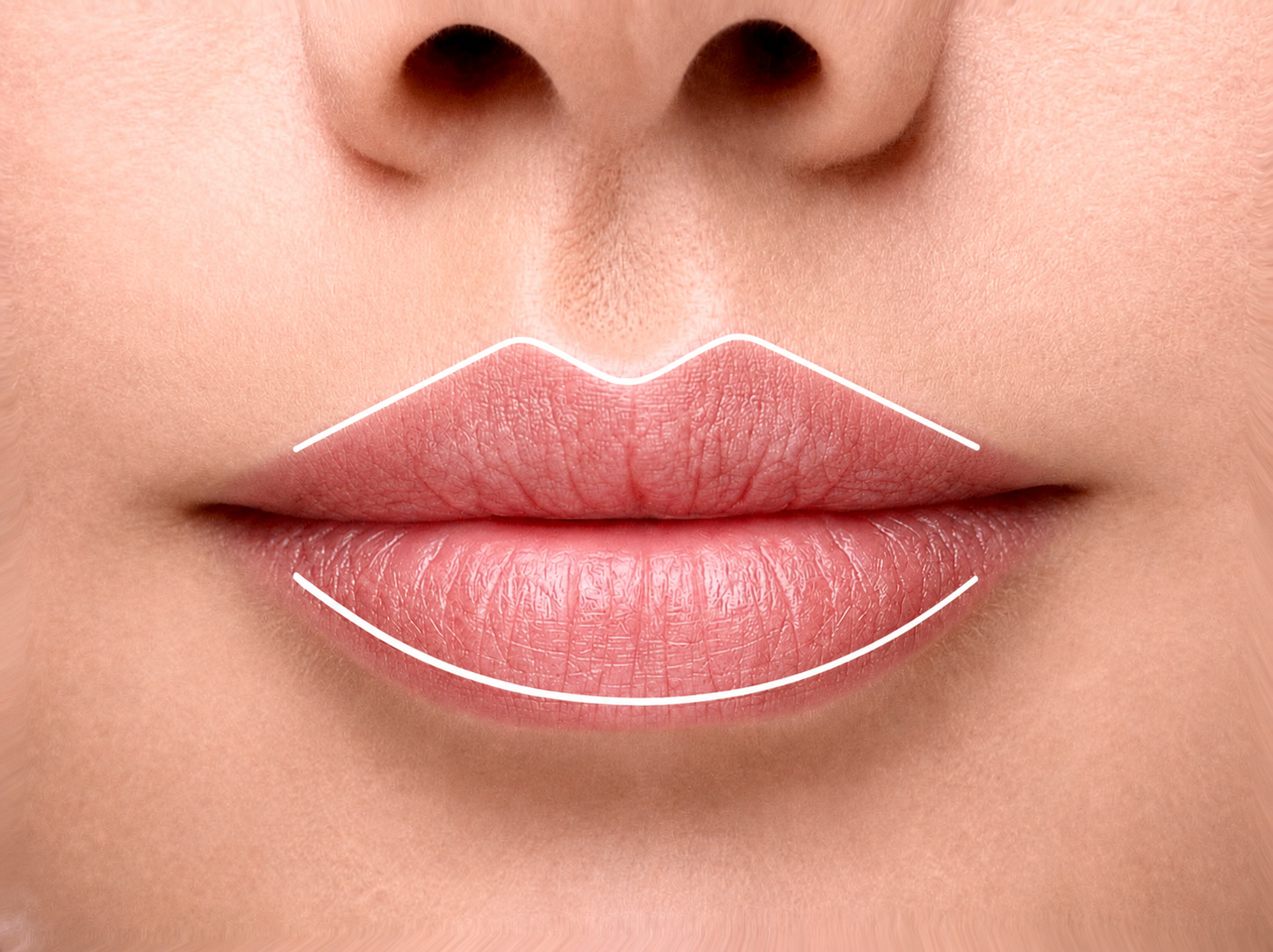 Lippenkontur und Lippenlinie mit Hyaluron in Z&uuml;rich
