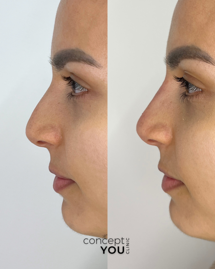 Vorher-nachher Ergebnis einer nicht-operativen Nasenkorrektur mit Hyaluron zur Begradigung des Nasenrückens
