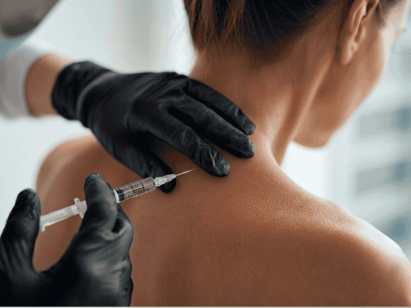 Diagramm der Botox-Migräne-Injektionspunkte an Stirn, Schläfen, Nacken und Schultern