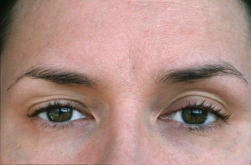 DROOPY EYELIDS