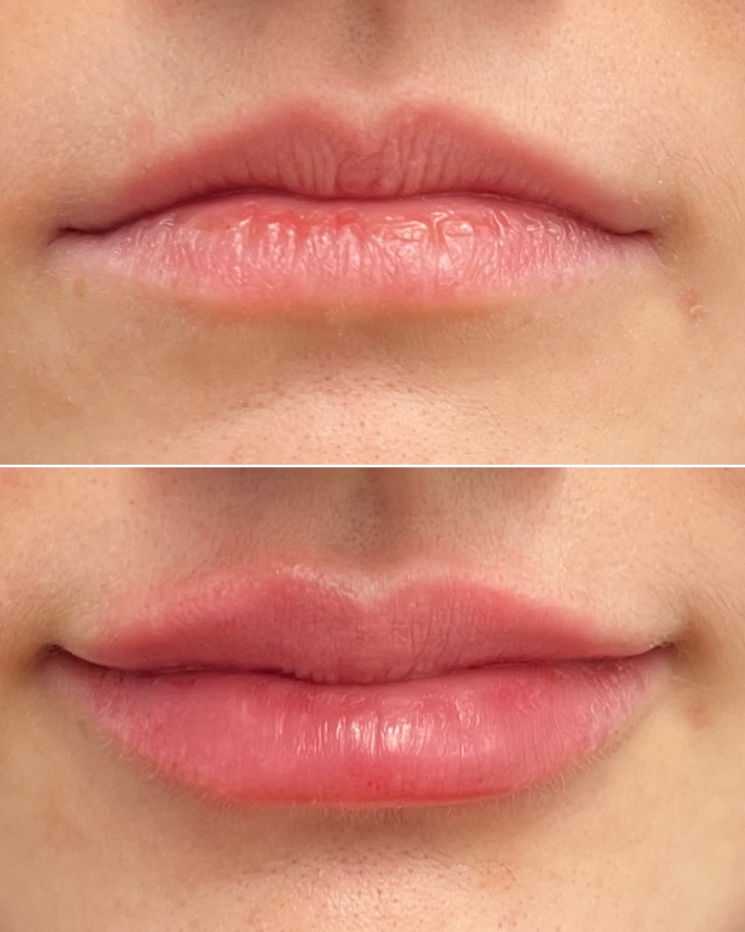 Lippenunterspritzung mit Hyalurons&auml;ure &ndash; Vorher-Nachher-Vergleich 2