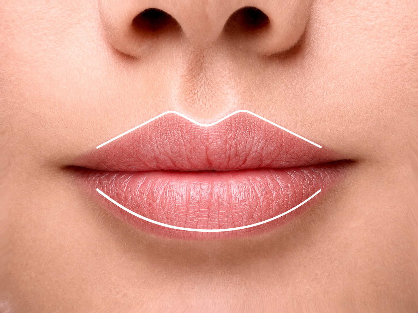 Lippenkontur und Lippenlinie mit Hyaluron in Z&uuml;rich