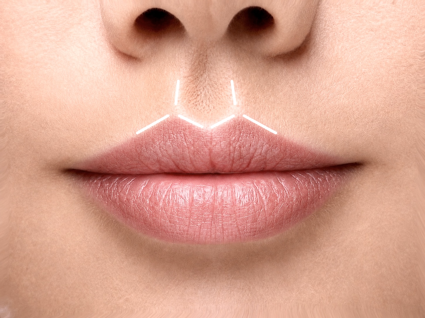 Philtrum und Amorbogen der Lippen betonen