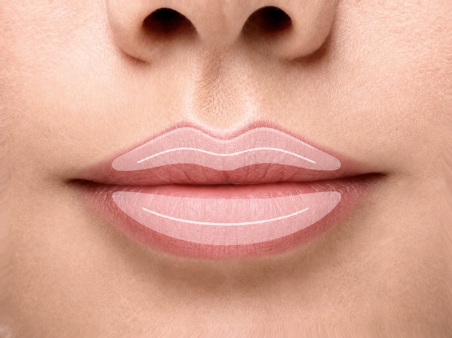 Lippenvolumen aufbauen mit Hyaluron in Z&uuml;rich
